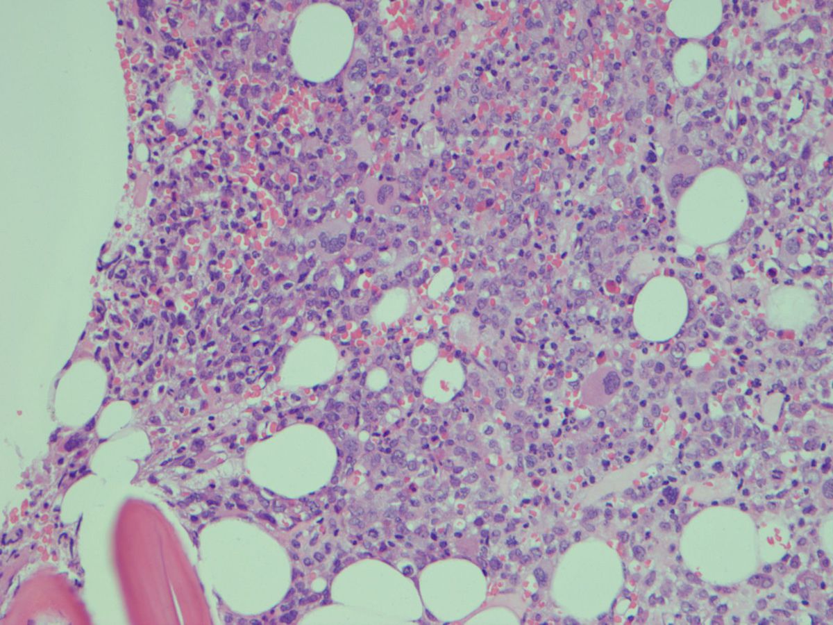 Acute myeloid leukemia arising in background of myelodysplasia 